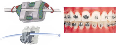 ortodencia brackets