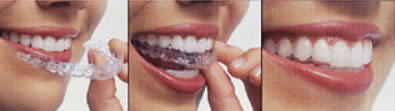 ortodoncia invisalign