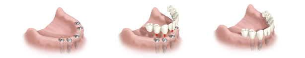 rehabilitacion de arcada inferior completa con implantes