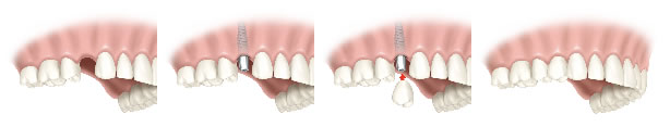 sustitucion una pieza dental como implante unitario