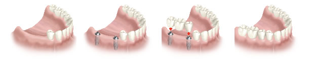 tres piezas dentales con dos implantes puente sobre implantes